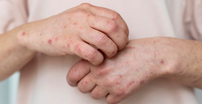 29-de-octubre-dia-mundial-de-la-psoriasis